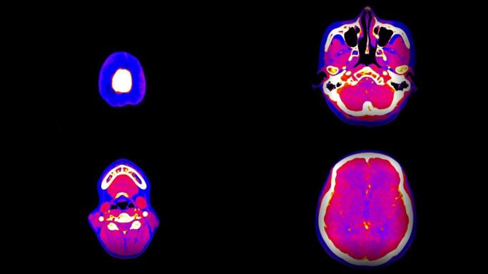 CTA脑或CT血管造影的脑轴视图融合粉红色。