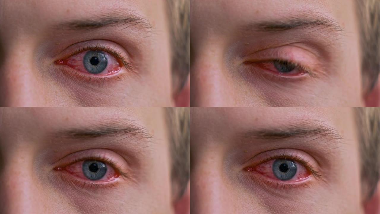 因结膜炎或流感，感冒或过敏后，男性烦躁的抽搐红血蓝眼睛。健康、疾病和治疗的概念。充满毛细血管网的眼睛