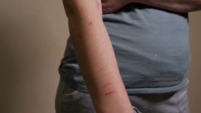 女人手上的抓痕和咬伤
