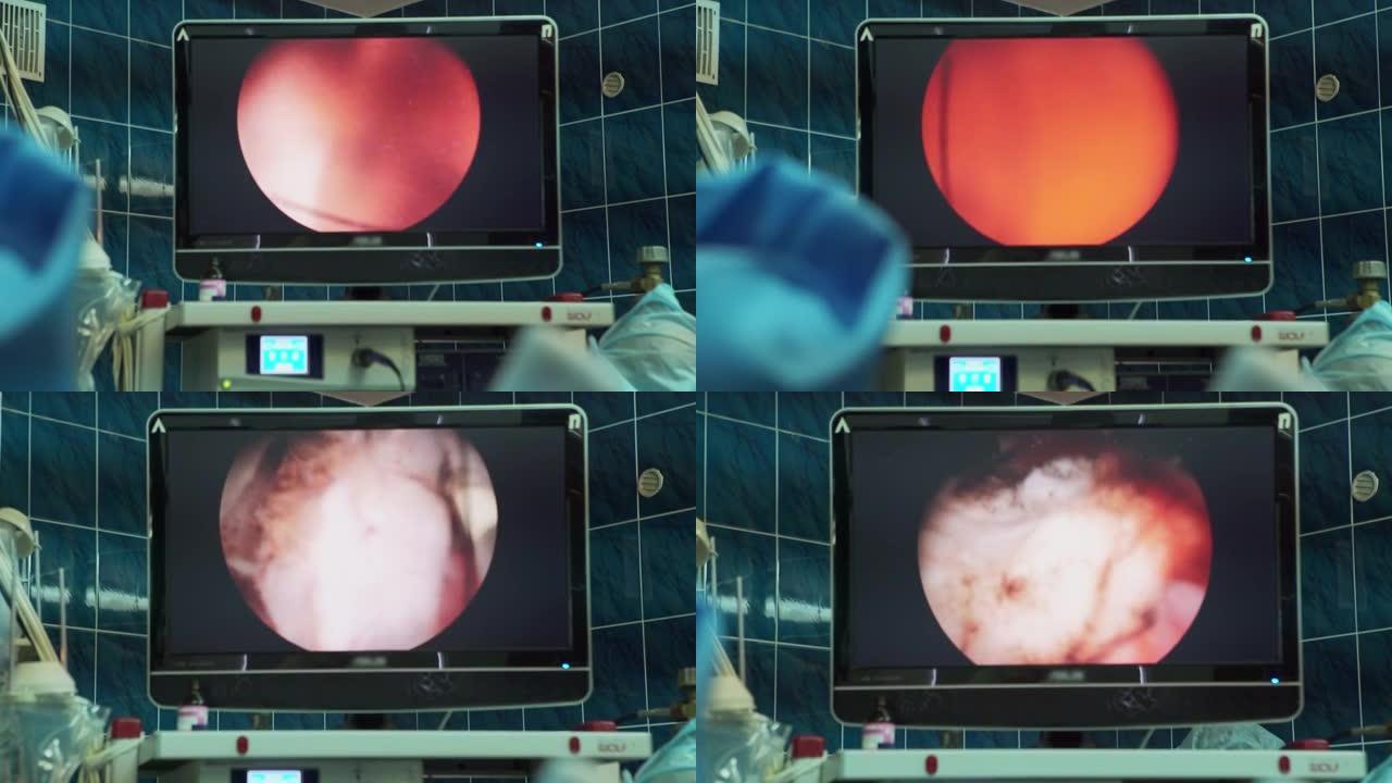 操作过程中，在监视器屏幕上进行前列腺切除术。前列腺腺瘤的治疗