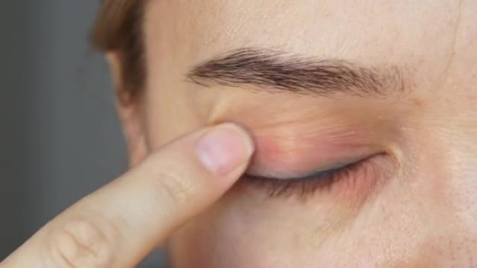 女性手部涂片油膏发炎，眼睑发红。过敏眼睑肿胀的治疗。眼睛过敏的女人。