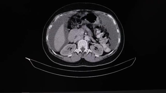 胃癌患者腹部的ct扫描。