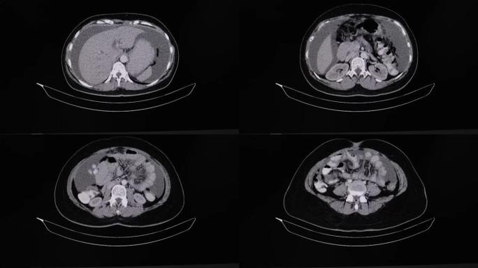 胃癌患者腹部的ct扫描。