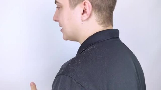 男人肩膀上的头皮屑。一个男人的侧视图，他的黑色衬衫上有更多的头皮屑片。头皮疾病治疗理念。真菌感染引起