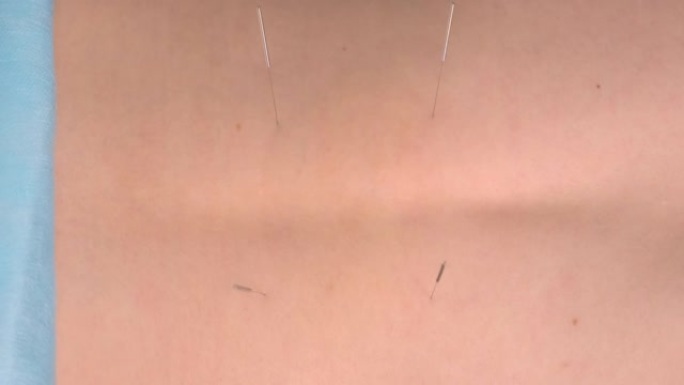 针灸师的手将针灸针插入女人的背部。