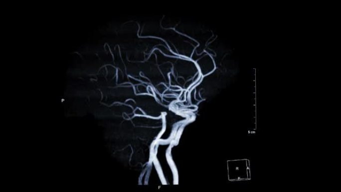 MRA脑或脑磁共振血管造影显示脑动脉。
