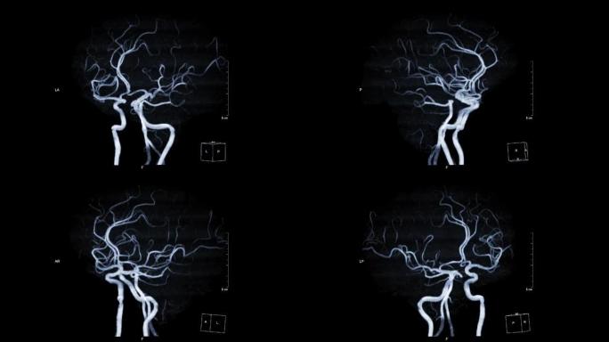MRA脑或脑磁共振血管造影显示脑动脉。