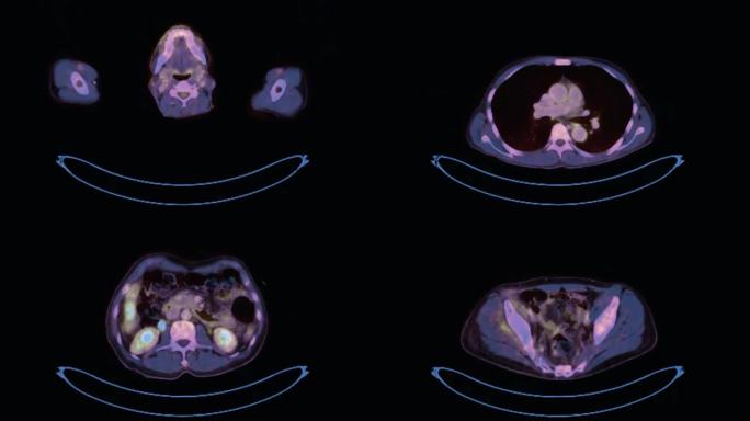 全人体三维PET CT (正电子发射断层扫描) 渲染图像轴视，用于检测术后肿瘤复发。