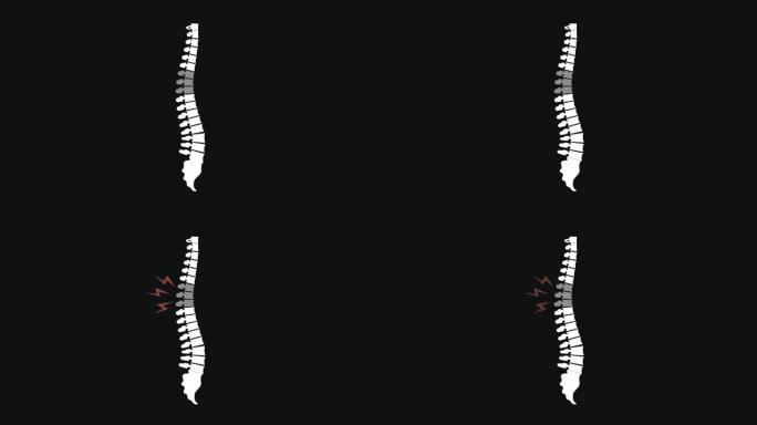 背部疼痛动画插图与脊柱。重点关注脊椎区域