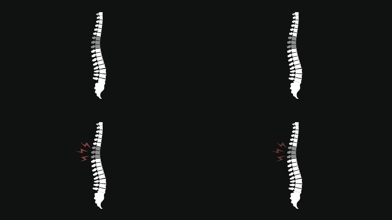 背部疼痛动画插图与脊柱。重点关注脊椎区域