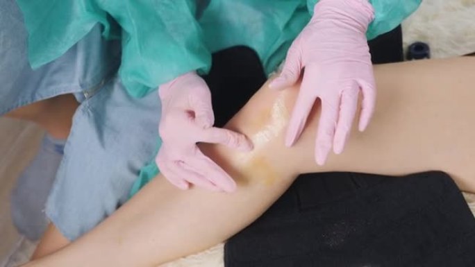 医生戴着医用手套的手的特写镜头，将药膏摩擦到患者膝盖的受损部位。