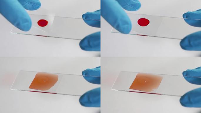 实验室血液测试。医生测试患者的血液，将血液滴到载玻片上，并用盖玻片覆盖