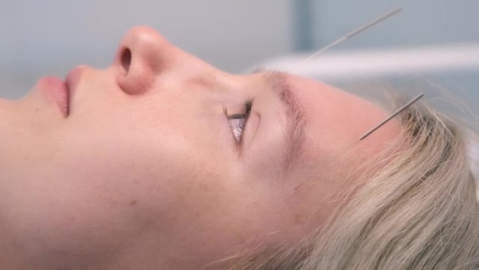 针刺治疗用针插入女人的脸上，特写侧视图