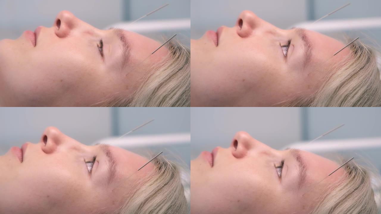 针刺治疗用针插入女人的脸上，特写侧视图
