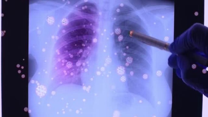 医生手显示受冠状病毒影响的肺部x线摄影