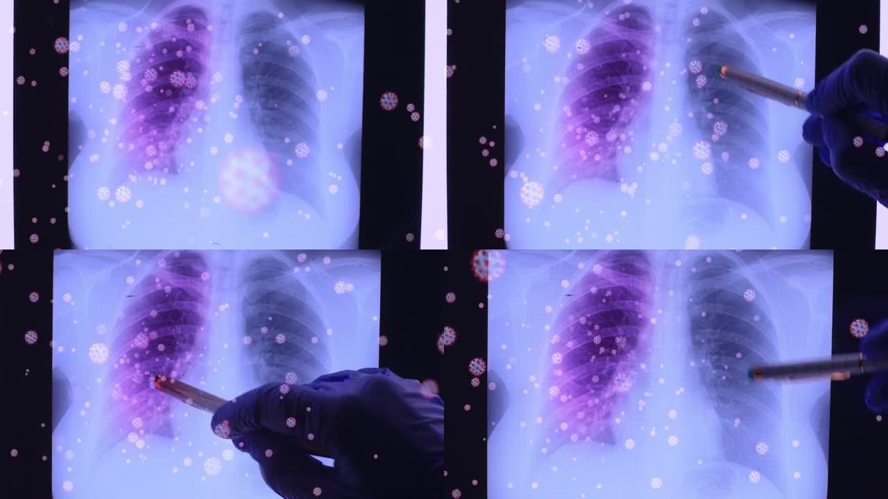 医生手显示受冠状病毒影响的肺部x线摄影