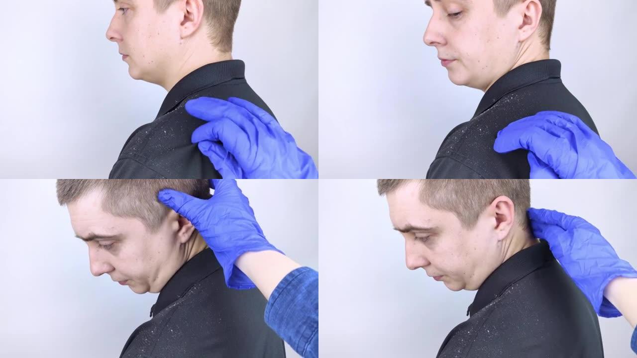 男人肩膀上的头皮屑。一个男人的侧视图，他的黑色衬衫上有更多的头皮屑片。头皮疾病治疗理念。真菌感染引起