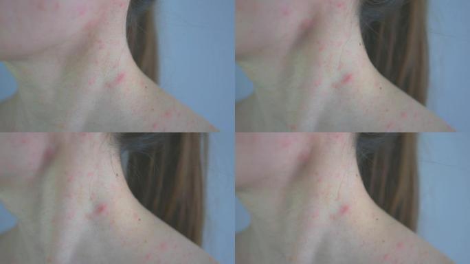 一名马尾辫扎着棕色头发的妇女的特写镜头显示出过敏反应，面部和颈部出现红疹。过敏性皮炎