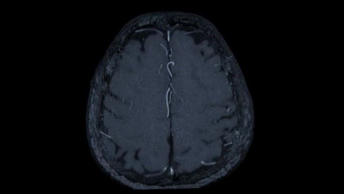MRA脑或磁共振血管造影的脑轴向MIP视图显示脑动脉。