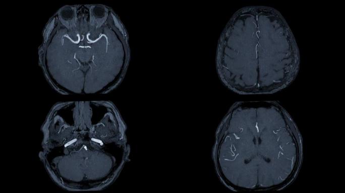 MRA脑或磁共振血管造影的脑轴向MIP视图显示脑动脉。