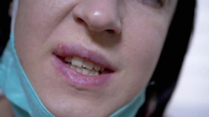 年轻的女孩显示疱疹病毒在嘴唇上，她藏在医用口罩下。4K