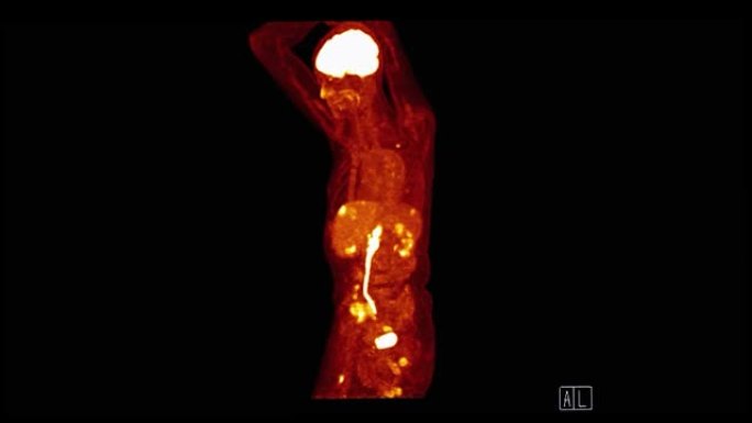 PET CT (正电子发射断层扫描) 全身三维渲染图像冠状视图红色色调，用于检测肿瘤术后复发。
