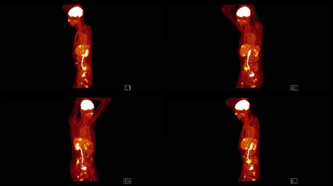 PET CT (正电子发射断层扫描) 全身三维渲染图像冠状视图红色色调，用于检测肿瘤术后复发。