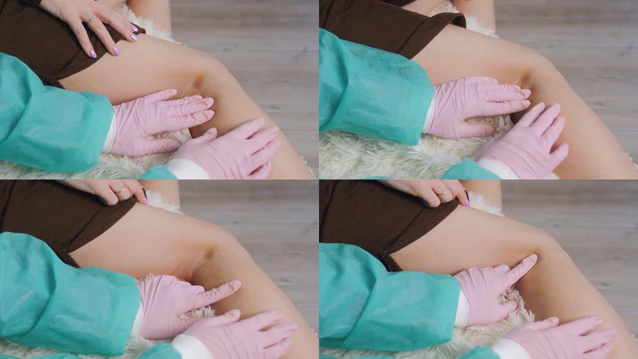 一名戴着医用手套的医生检查了患者女性膝盖内侧的瘀伤以及受伤造成的伤害。