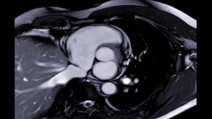 心脏的MRI心脏或心脏的MRI (磁共振成像) 在冠状视图中显示4个心脏室，用于诊断心脏病。