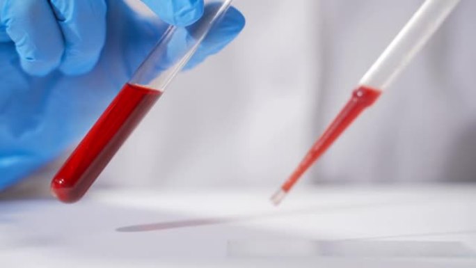 冠状病毒验血，带防护手套的女实验室技术员拿着移液器，在医院病房中检测血液样本以进行输血