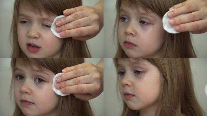 母亲的双手将无菌的棉球消毒到小女孩的眼睛。伤害治疗。
