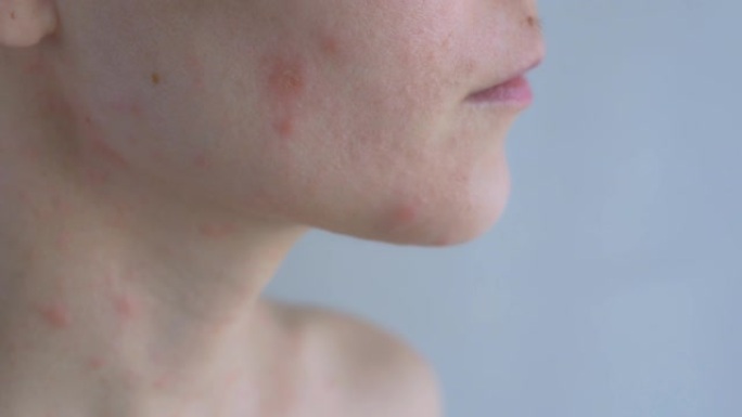 皮肤有问题的女人。在女人的脸部和颈部区域，出现各种大小的红斑。过敏性皮炎。特写
