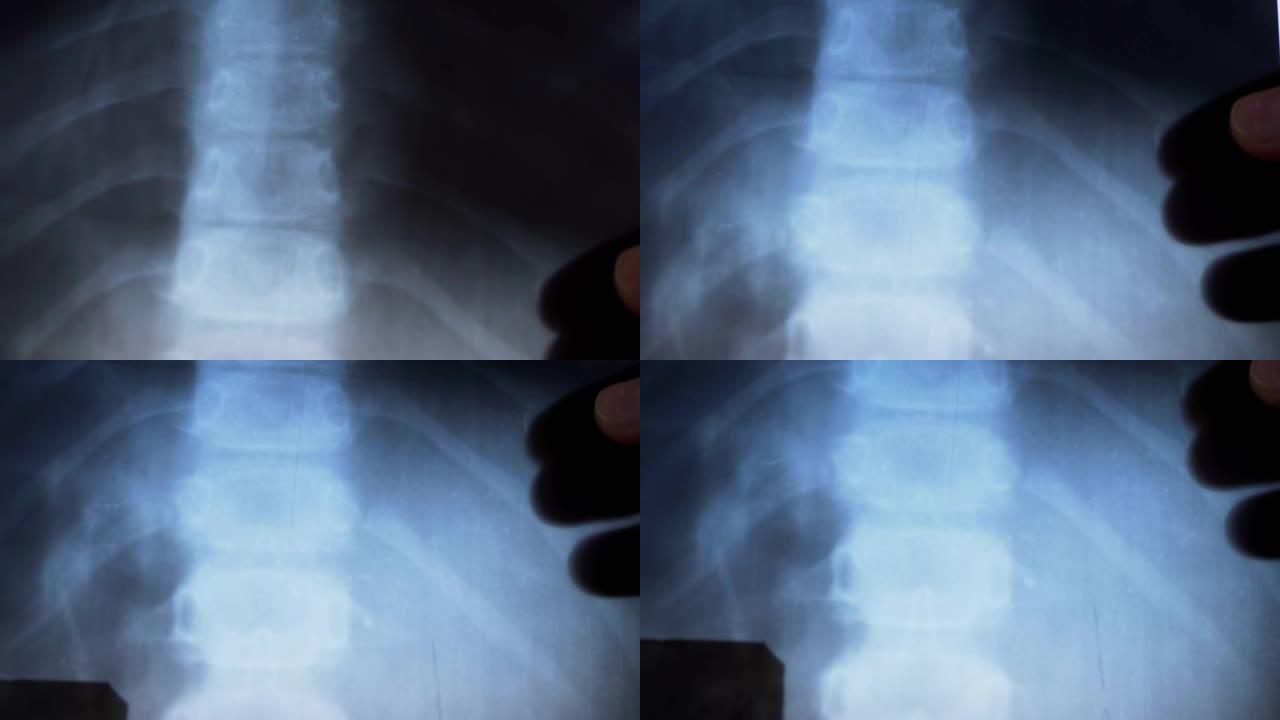 一个小孩的脊椎，肋骨，骨头的x光。脊柱弯曲。脊柱后凸。4K