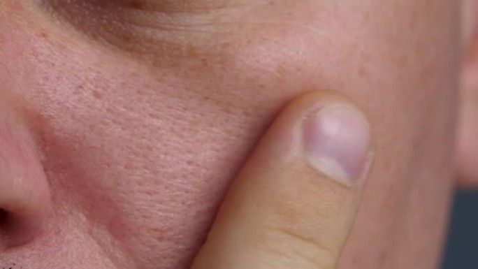 脸颊上靠近鼻子的面部痤疮或丘疹