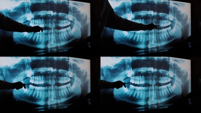 大屏幕上的牙齿x光。医生的手显示出一颗坏牙
