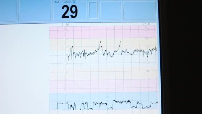 数值。监视器显示病人的心跳。健康分析。
