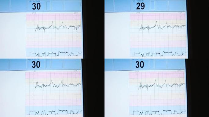 数值。监视器显示病人的心跳。健康分析。