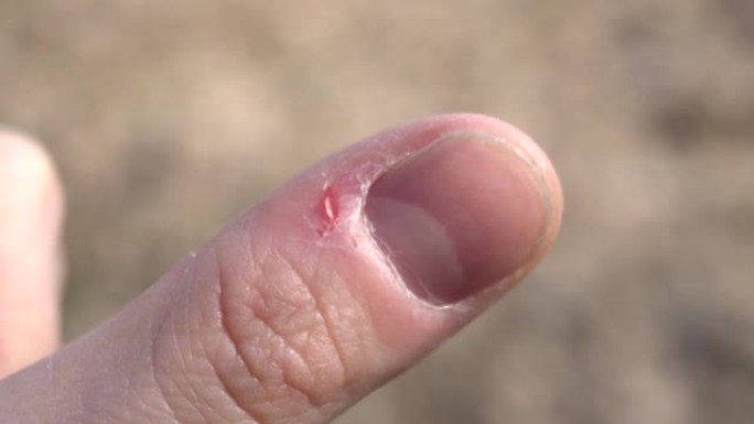 指甲咬了，毛刺破了，胳膊上的皮肤破了。问题修指甲,特写