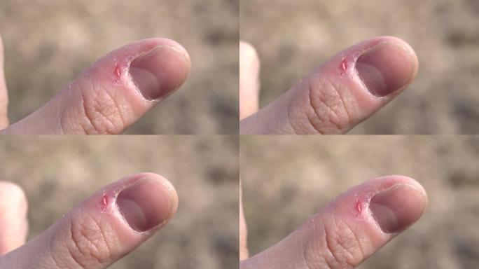 指甲咬了，毛刺破了，胳膊上的皮肤破了。问题修指甲,特写