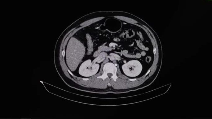 男性脂肪肝患者腹部的ct扫描。