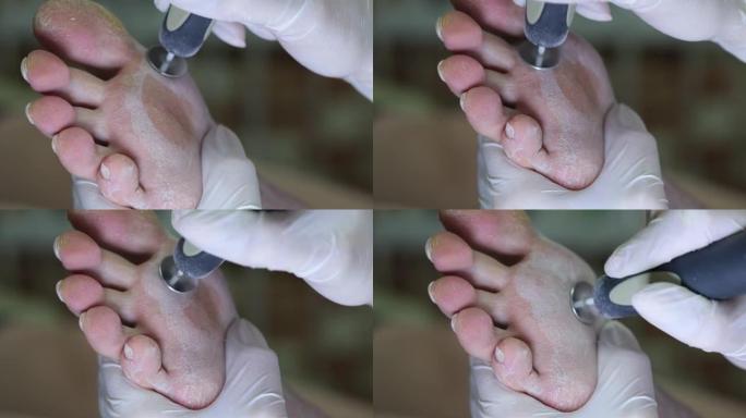 足部治疗，用仪器清洁粗糙的干燥皮肤。