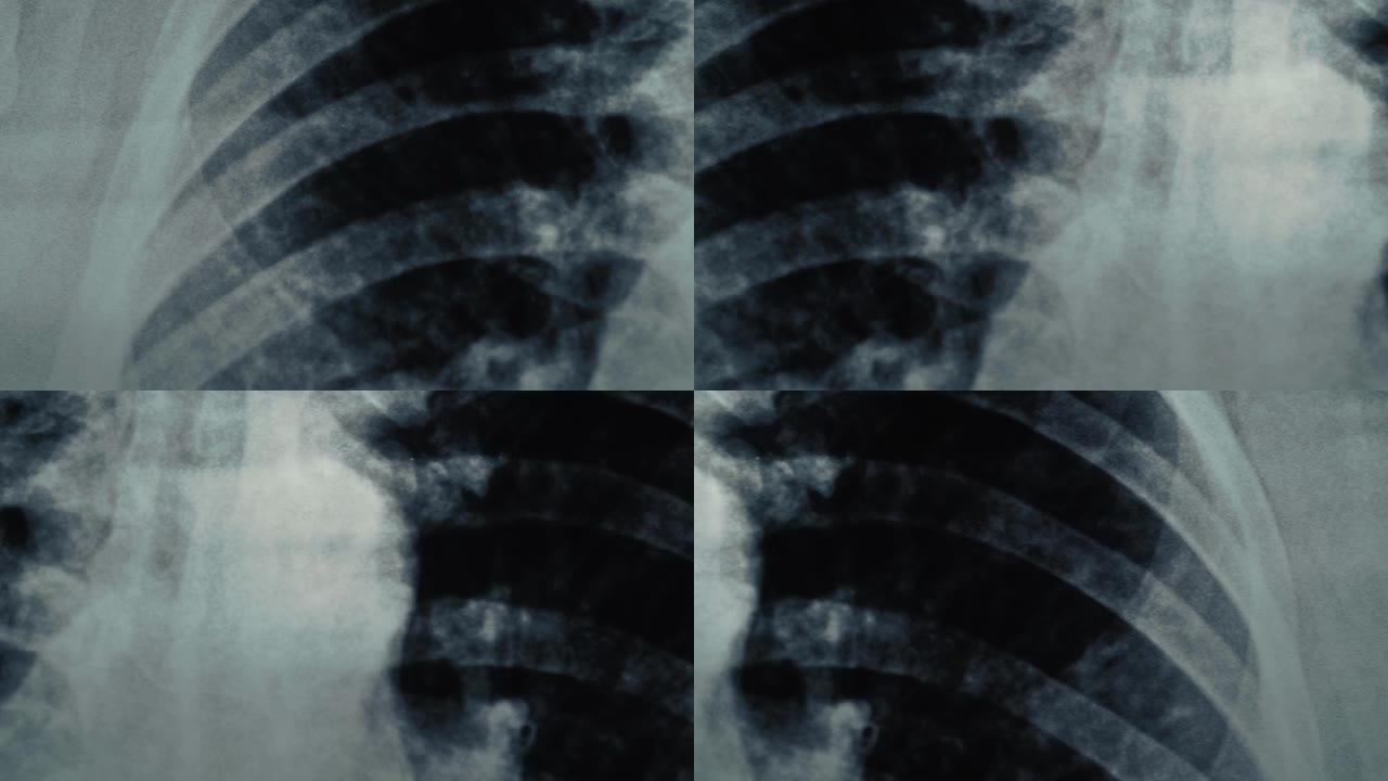 放射胸部x光片的全景宏观拍摄。哮喘，新型冠状病毒肺炎，冠状病毒或肺炎诊断概念