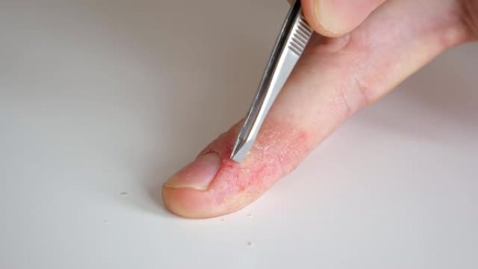医生用镊子刮擦皮肤进行分析。男性手指有银屑病和湿疹