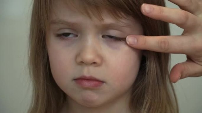 母亲的双手在小女孩消炎膏的眼睛上涂抹瘀伤。伤害治疗。健康和护理概念