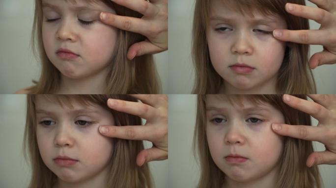 母亲的双手在小女孩消炎膏的眼睛上涂抹瘀伤。伤害治疗。健康和护理概念