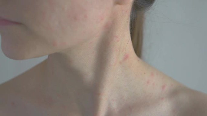 在面部和颈部，女性对抗生素产生过敏反应。身上有淡红色小疙瘩的皮疹。过敏性皮炎。特写