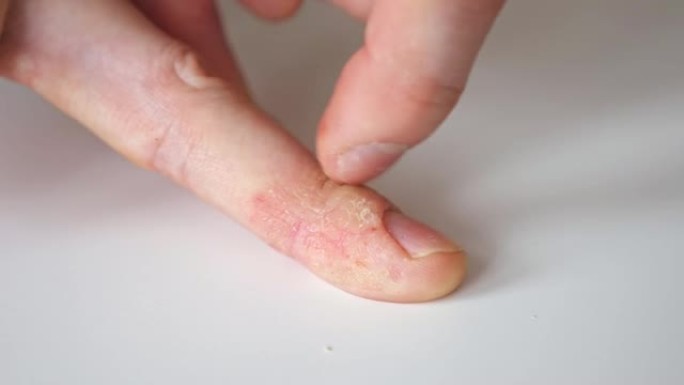 患有牛皮癣和湿疹的男人的手指。