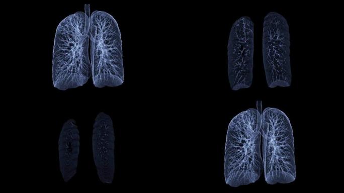 CT胸部或肺部3D渲染图像在屏幕上翻转以诊断结核病，结核病和新型冠状病毒肺炎。