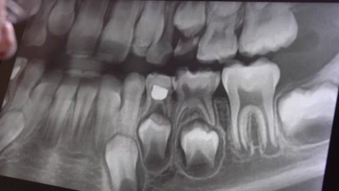男性牙医在防护眼镜中检查的全景牙科x射线图像