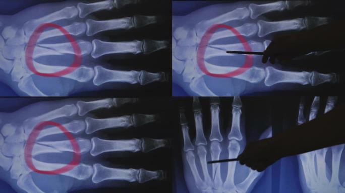 手骨骨折的x光。医生显示骨折。